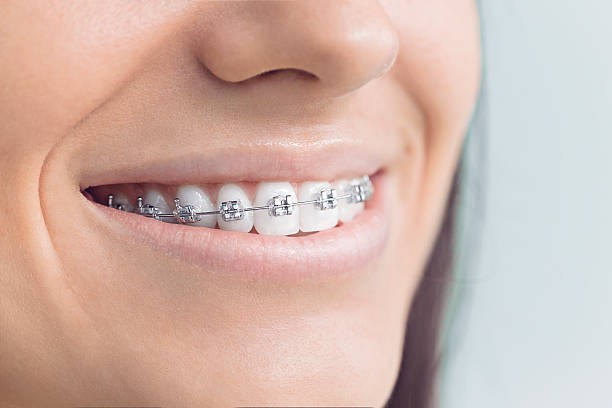 Tandreglering av krokiga tänder: Rätta upp ditt leende